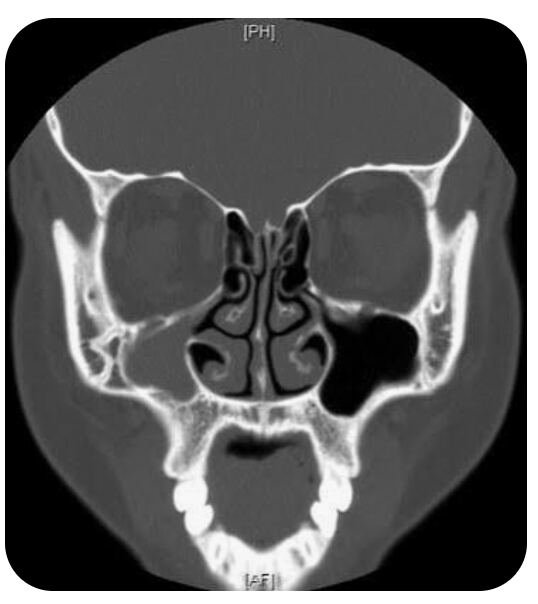 Chirurgie de la sinusite — imagerie scanner des sinus